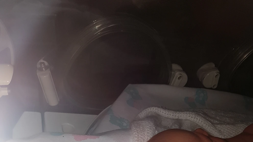 Hlavička malej Izabelke po páde veľmi opuchla.