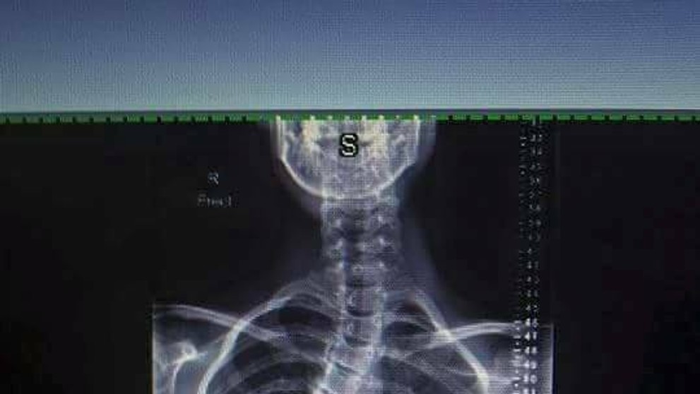 Sam Hansen a röntgen jej chrbtice.