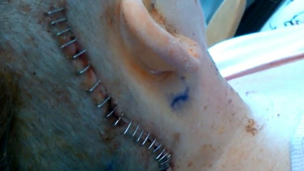 Jayne Reffin po operácii.