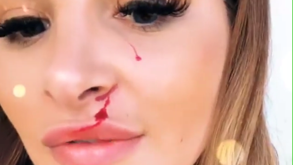 Čo sa jej stalo? Zuzana Plačková ukázala zakrvavenú tvár