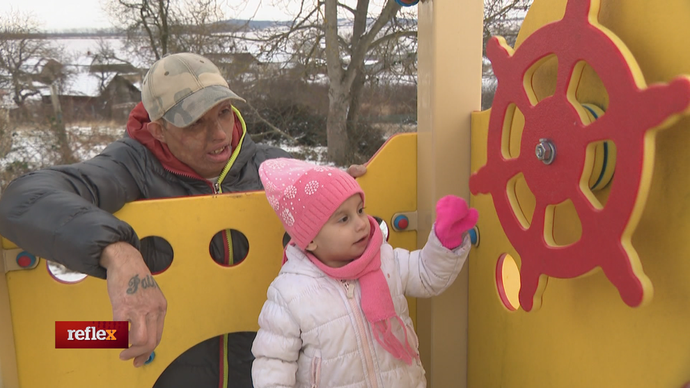 Má popáleniny po celom tele