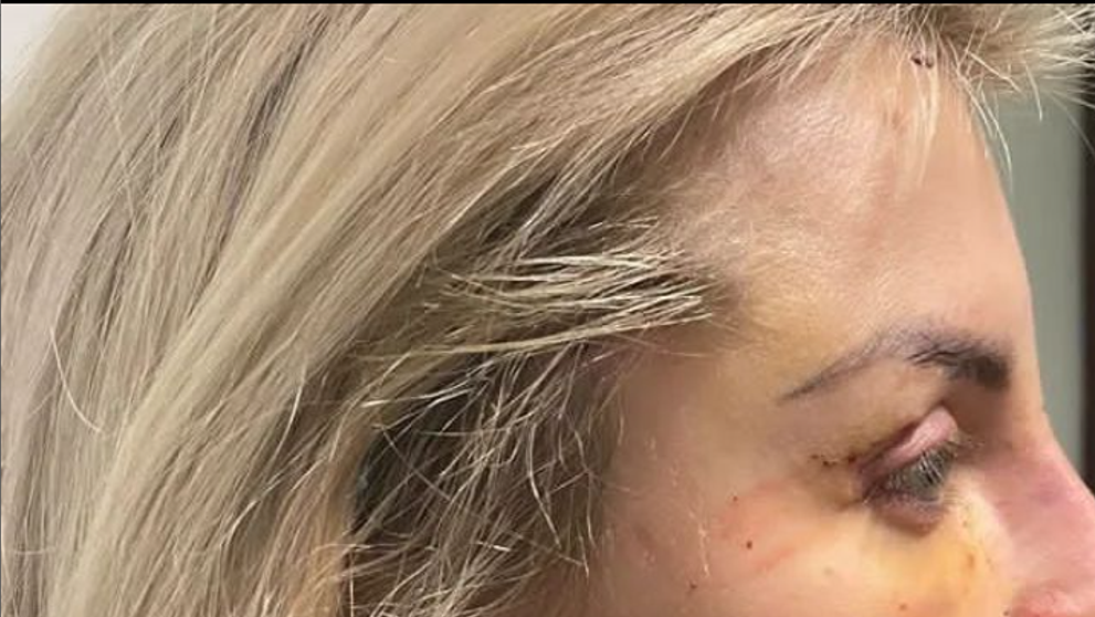 Lela Ceterová po obrovskej kritike: Pochválila sa novým nosom