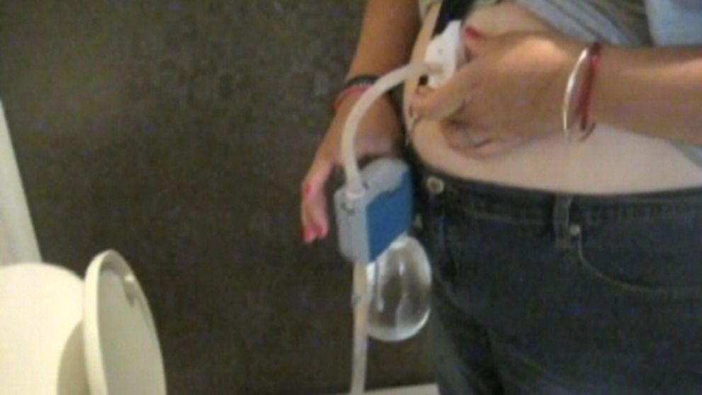 Vysávanie žalúdka