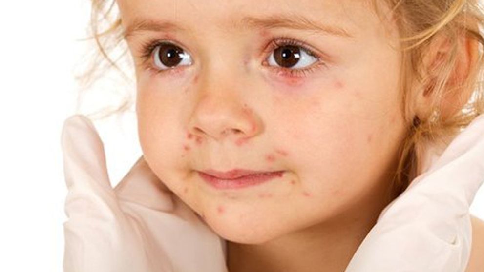 Pozor na riskantné kiahňové večierky!!!