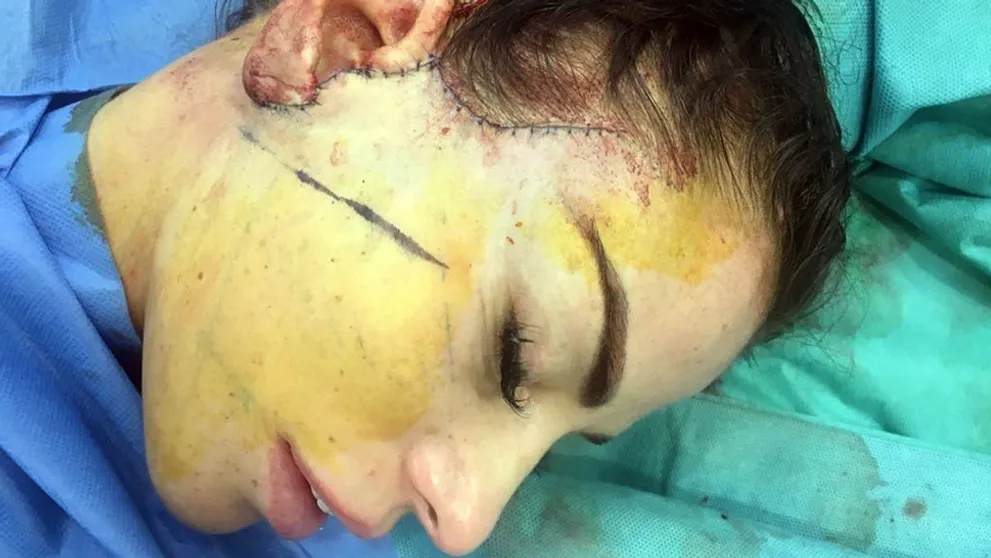 Len pre silné žalúdky! Modelka zverejnila zábery z kozmetického zákroku