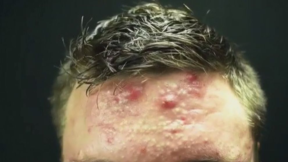 Kulturistu trápilo nechutné akné. Pomohla mu banálna vec