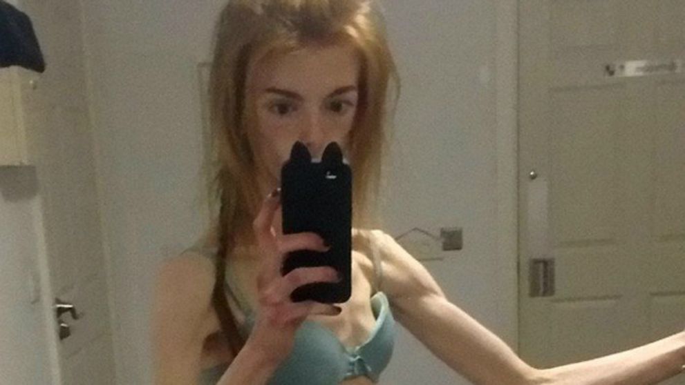 Anorektičke zachránila život jediná vec: Neuveríte aká!