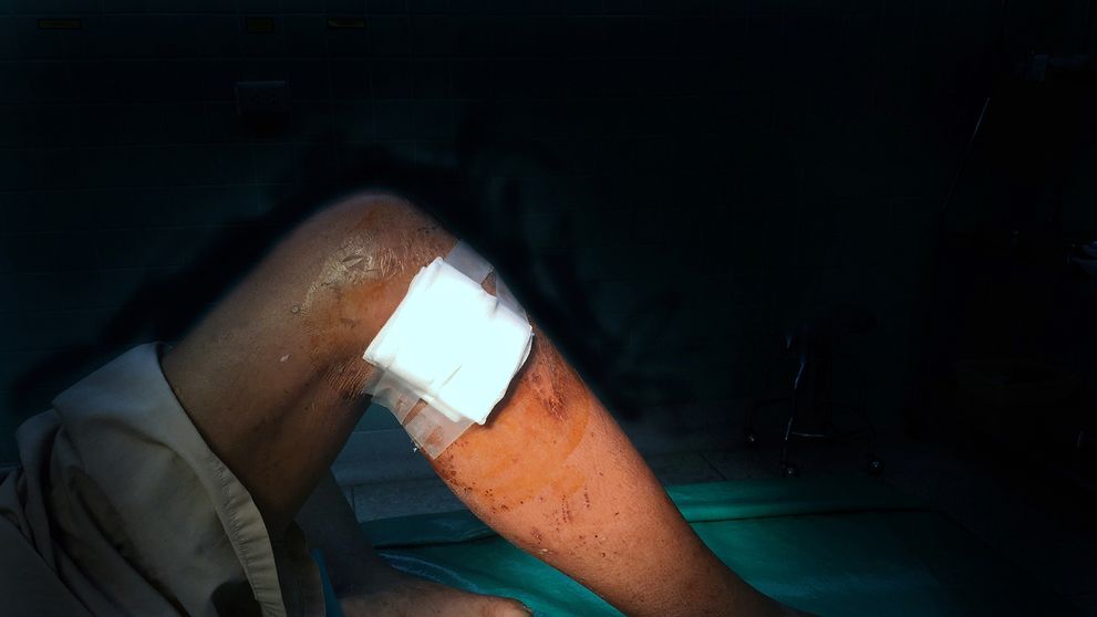 Doteraz ste to videli len vo filme. Gél zocelí ranu za 60 sekúnd