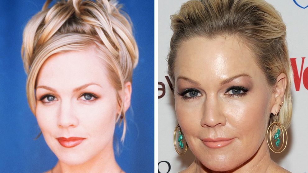 Aj ona podľahla plastike. Kelly z Beverly Hills natiahnutá a pribratá