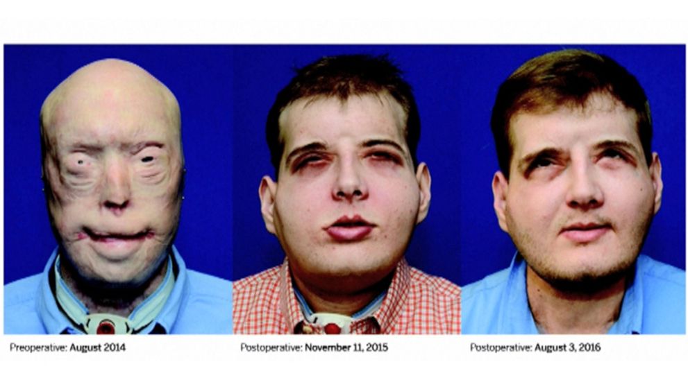 Plamene hasičovi znetvorili tvár, po 15 rokoch sa už môže usmievať