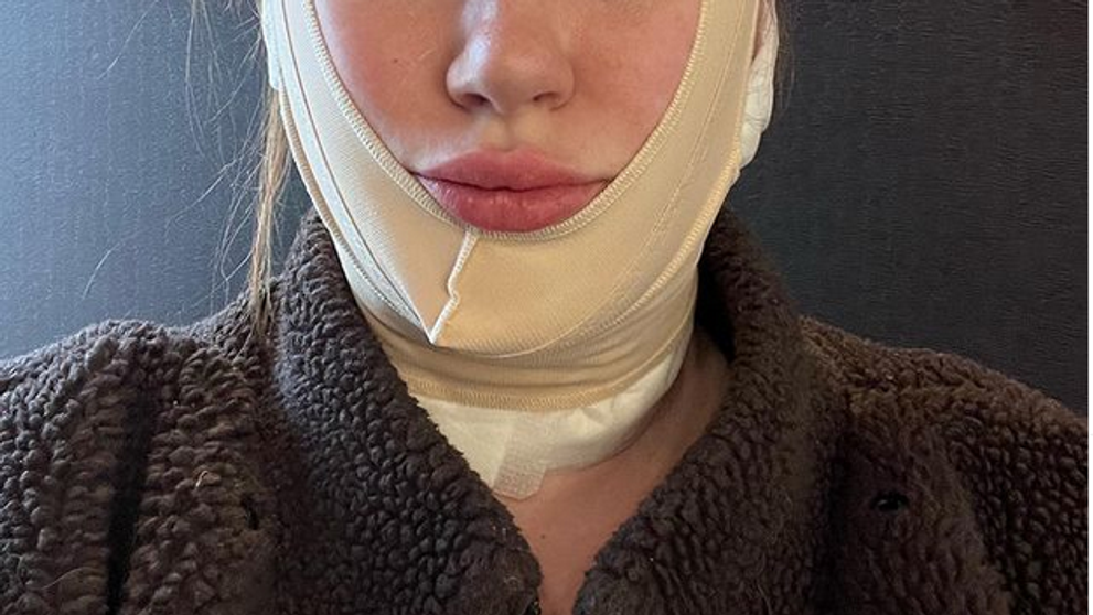 Nezačala nejako priskoro? Modelka šokovala fanúšikov úpravou tváre