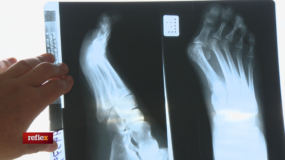 Halluxy vedia pacientov poriadne potrápiť