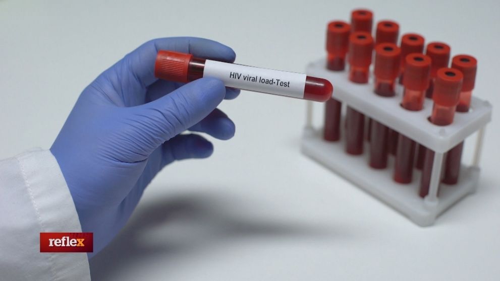 HIV pozitívni bez zubára