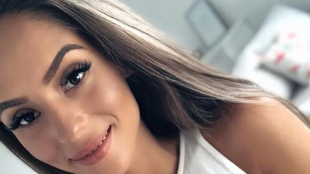 Českej youtuberke popálili na dovolenke tvár. Z komentárov ľudí je na vracanie