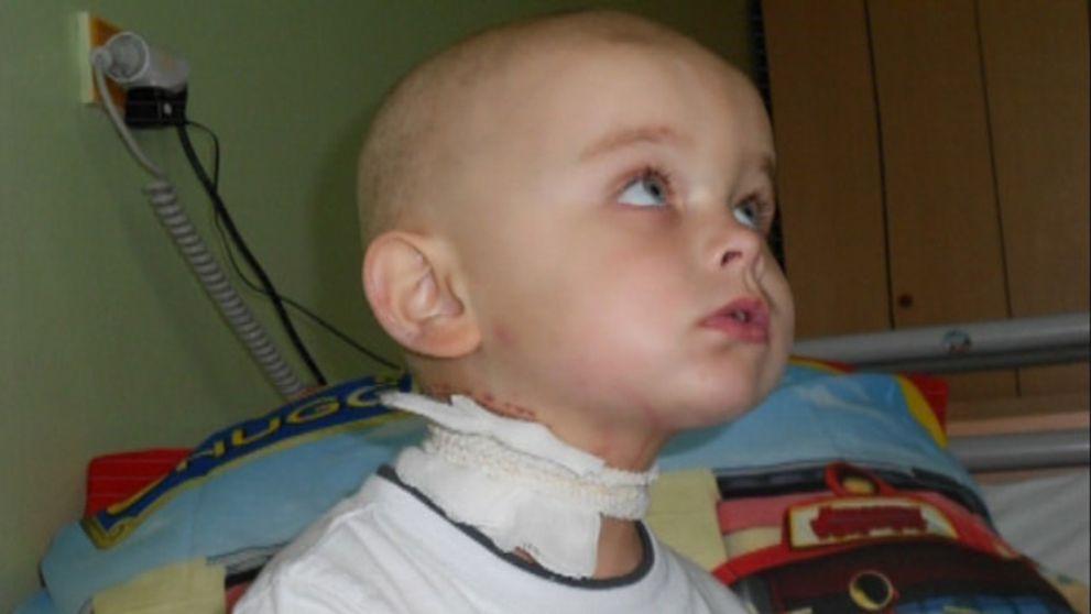 Rakovina namiesto angíny