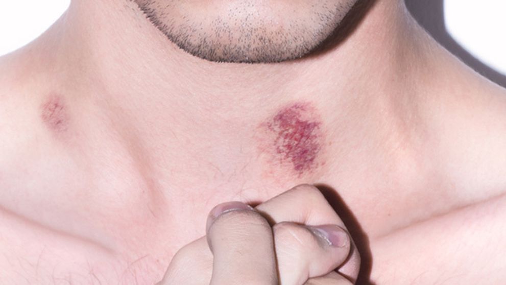 Cucflek na krku: Tieto veci vám pomôžu zbaviť sa ho