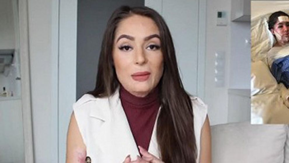 Popálená česká YouTuberka sa odhodlala: Ukázala fotku tesne po nehode