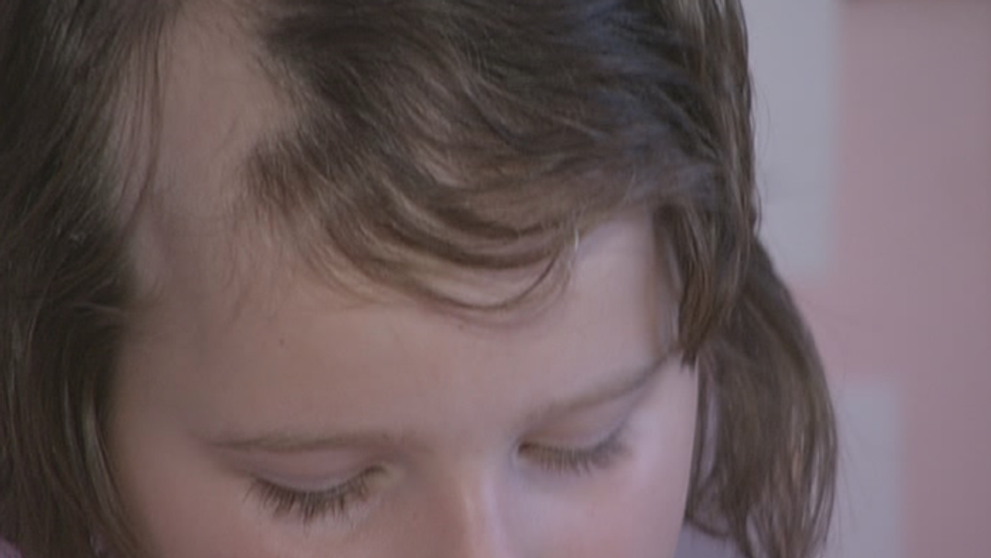 Alopécia je diagnóza, ktorá si nevyberá