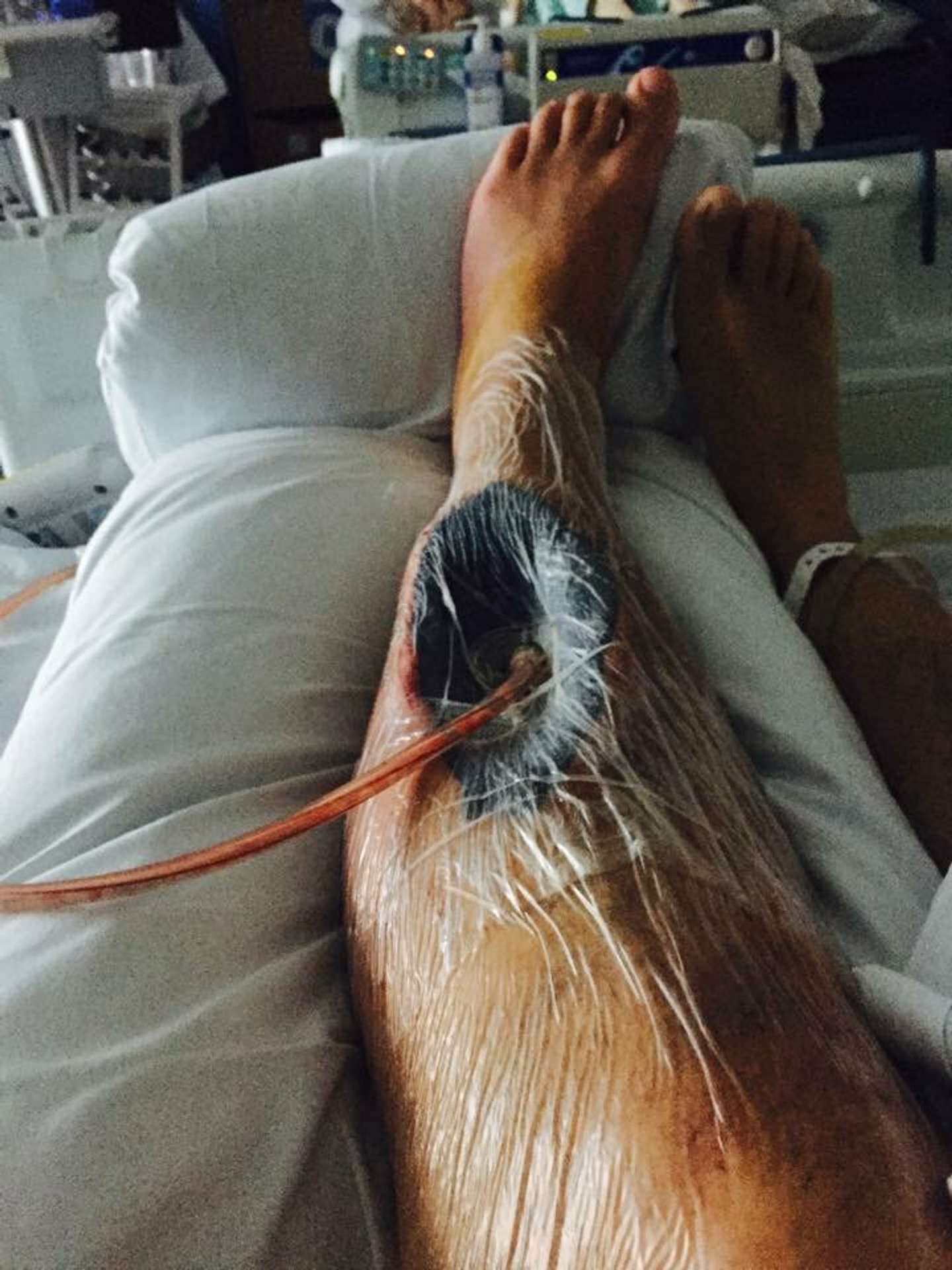 Lewisovi Brownovi museli vyrezať z nohy sval.