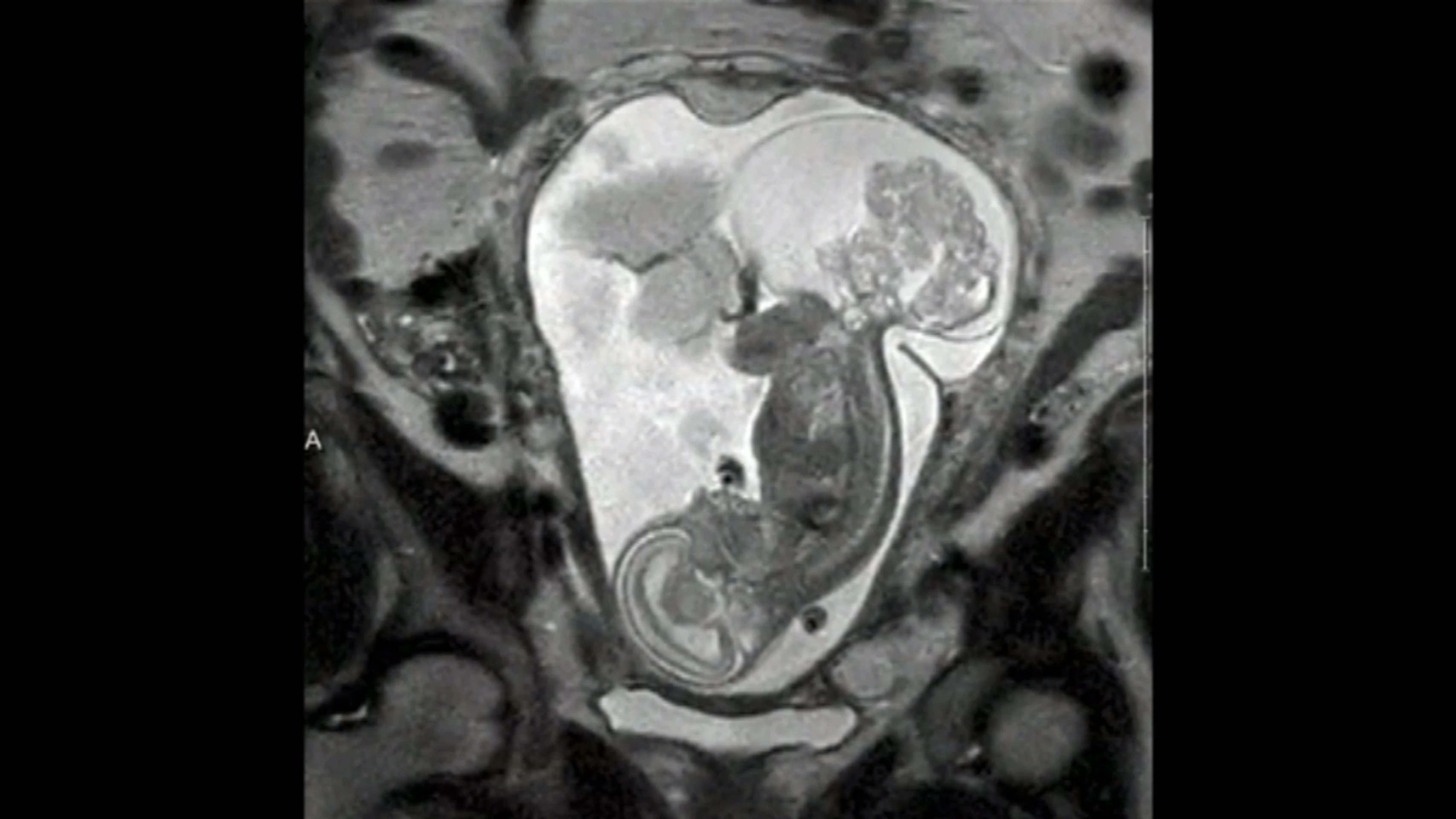 Dieťa a tumor