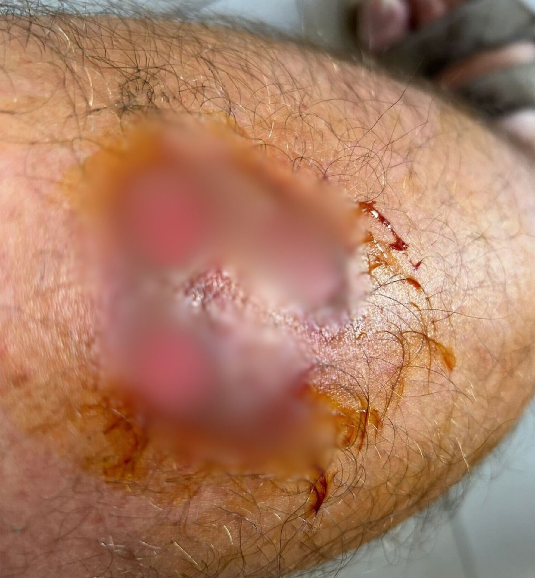 Miazga v spojení so slnkom spôsobila nepríjemné zranenia.