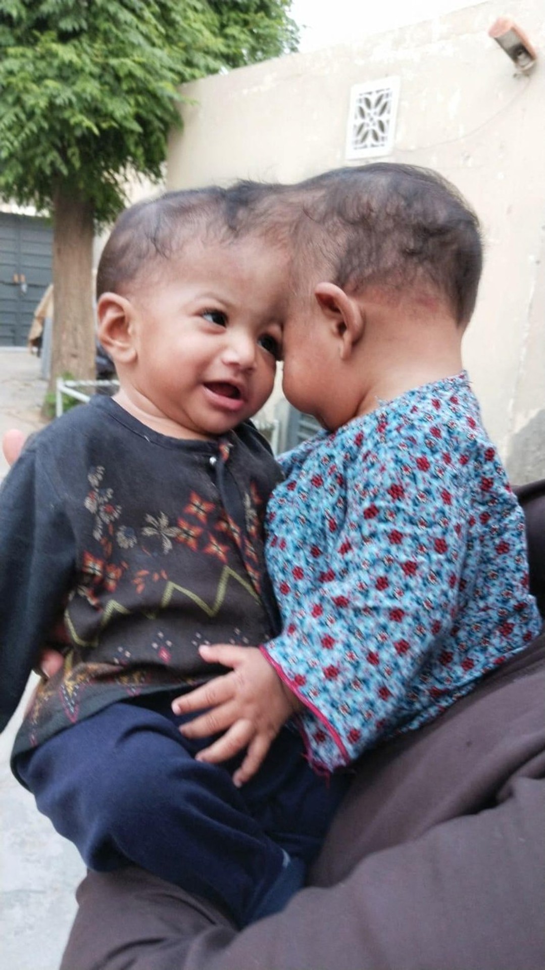 Dvojičky sa narodili so spojenými hlavami.