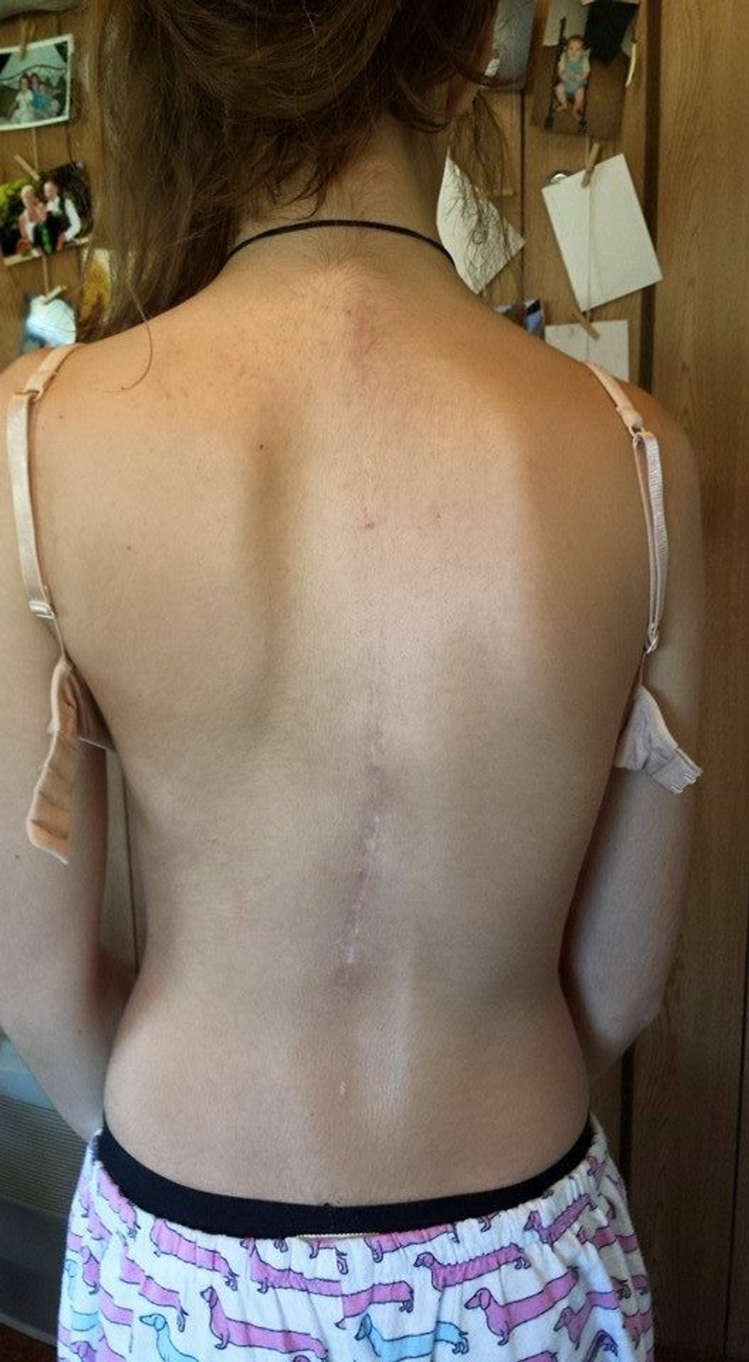 Sam Hansen a jej chrbtica teraz.