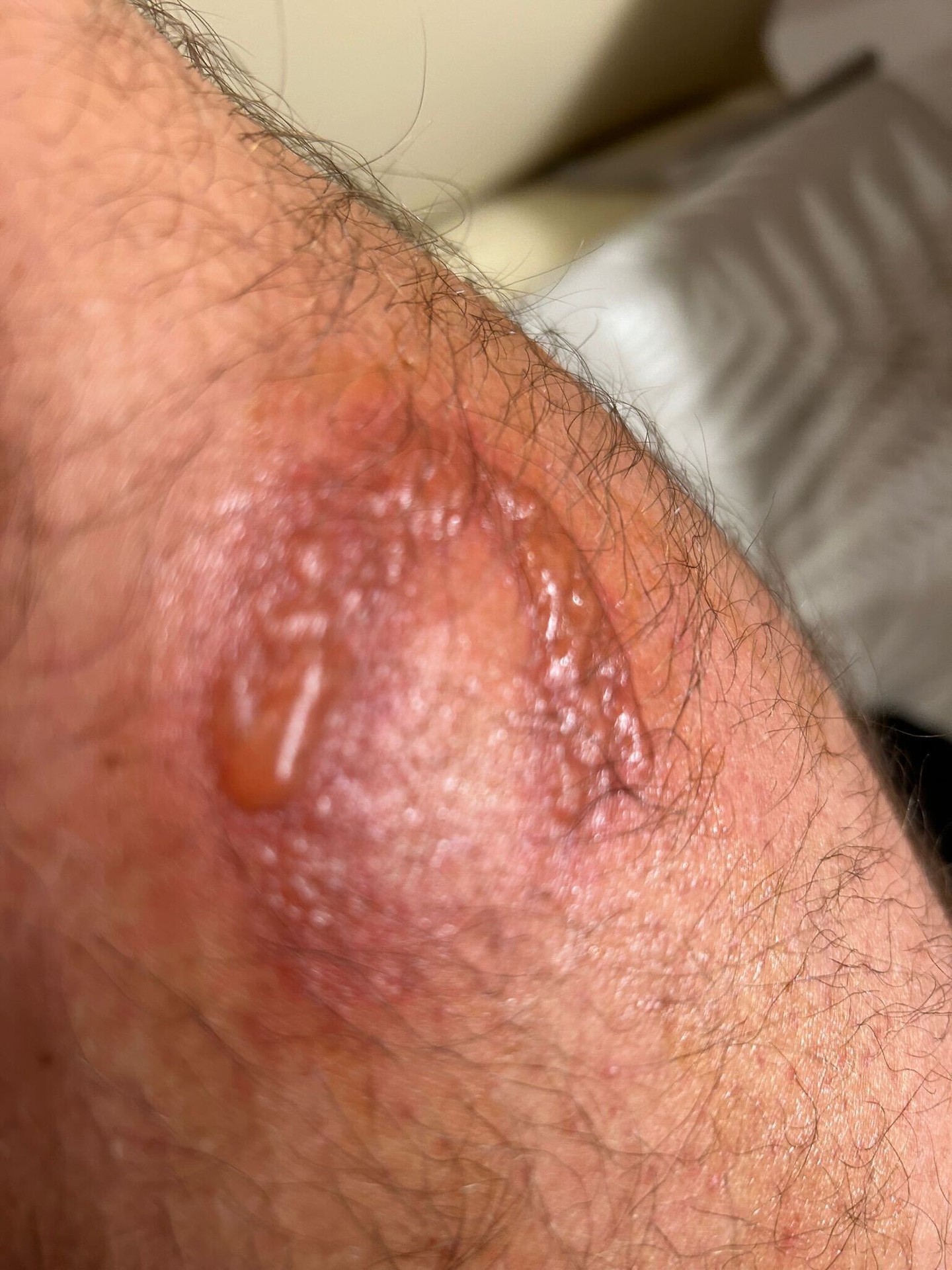 Miazga v spojení so slnkom spôsobila nepríjemné zranenia.