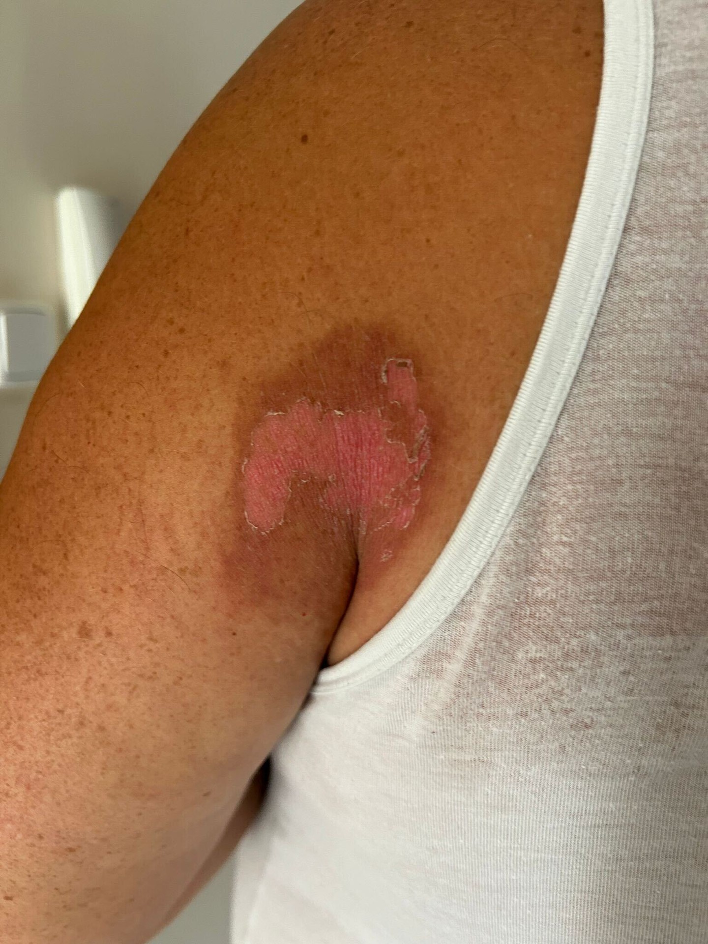 Miazga v spojení so slnkom spôsobila nepríjemné zranenia.